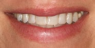 Before Image: Case 395 - front