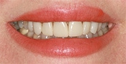 Before Image: Case 397 - front