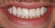 After Image: Case 398 - front