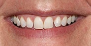 Before Image: Case 399 - front