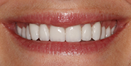 After Image: Case 40 - front