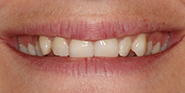 Before Image: Case 40 - front