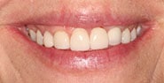 Before Image: Case 403 - front
