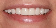 After Image: Case 404 - front