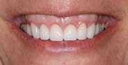 After Image: Case 406 - front