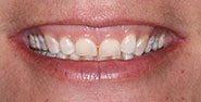 Before Image: Case 406 - front