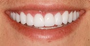 After Image: Case 407 - front