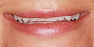 Before Image: Case 411 - front