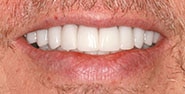 After Image: Case 413 - front
