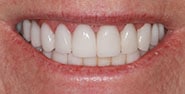 After Image: Case 414 - front