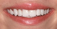 After Image: Case 415 - front