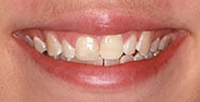 Before Image: Case 415 - front