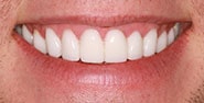 After Image: Case 416 - front