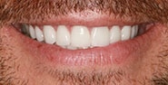 After Image: Case 417 - front