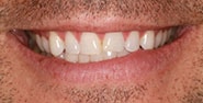 Before Image: Case 417 - front
