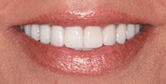 After Image: Case 419 - front