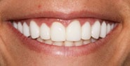 After Image: Case 422 - front