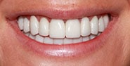After Image: Case 423 - front