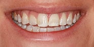 Before Image: Case 423 - front