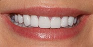 After Image: Case 424 - front