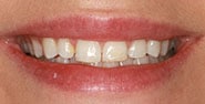 Before Image: Case 424 - front