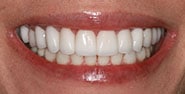 After Image: Case 425 - front
