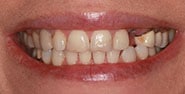Before Image: Case 425 - front