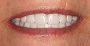 After Image: Case 426 - front
