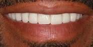 After Image: Case 427 - front