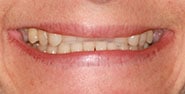 Before Image: Case 428 - front