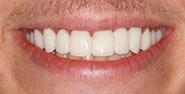 After Image: Case 429 - front