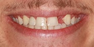 Before Image: Case 429 - front
