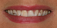 Before Image: Case 43 - front