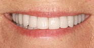 After Image: Case 430 - front
