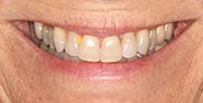 Before Image: Case 430 - front