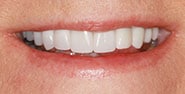After Image: Case 431 - front