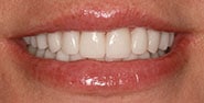 After Image: Case 432 - front