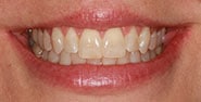 Before Image: Case 432 - front