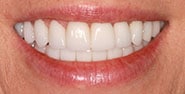After Image: Case 433 - front