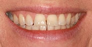Before Image: Case 433 - front