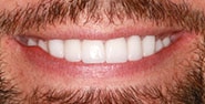 After Image: Case 434 - front