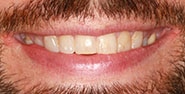 Before Image: Case 434 - front