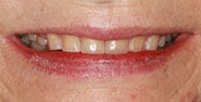 Before Image: Case 435 - front