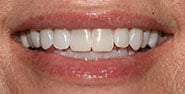 Before Image: Case 437 - front