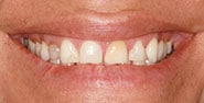 Before Image: Case 438 - front