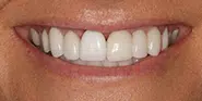 Before Image: Case 44 - front