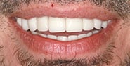 After Image: Case 440 - front