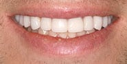 After Image: Case 442 - front