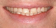 Before Image: Case 442 - front