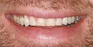 Before Image: Case 443 - front